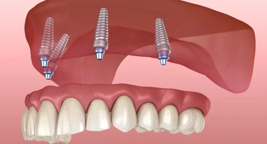 Implant-Supported Dentures